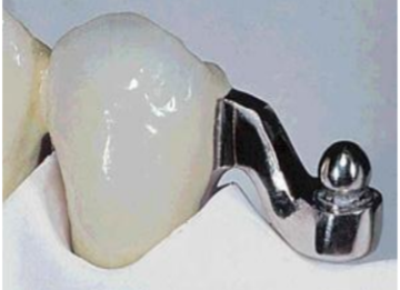 Chỉ định phục hình hàm khung kết hợp với khớp nối Preci
