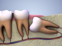 Tiên lượng sự phát triển và trục răng 8