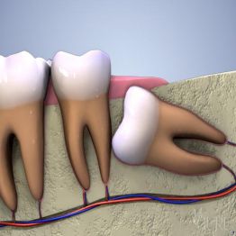Phân loại răng khôn trên phương diện lâm sàng