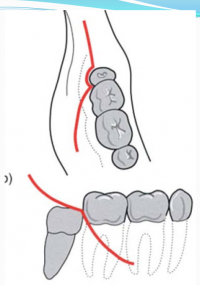 Đường rạch niêm mạc trong phẫu thuật nhổ răng khôn