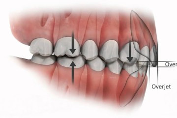 KHỚP CẮN LÝ TƯỞNG