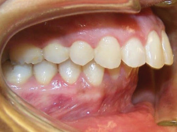KHỚP CẮN KHÔNG SINH LÝ