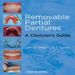 Removable Partial Dentures-A Clinician's Guide
