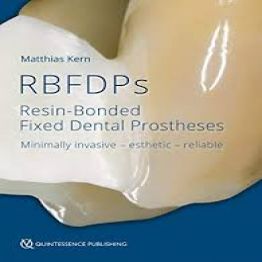 RBFDPs Resin-Bonded Fixed Dental Prostheses