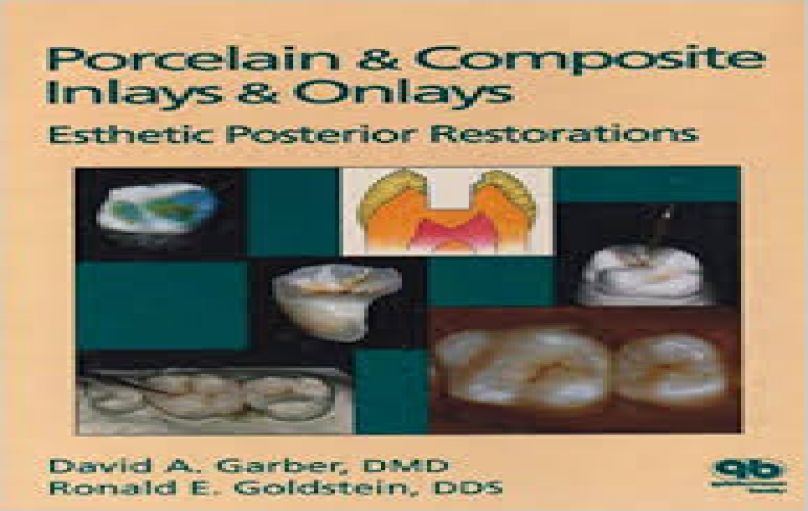Porcelin & Composite Inlays & Onlays-download