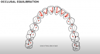 Bài 6:Chi tiết chỉnh khớp từng răng: Phần 1-Chỉnh khớp răng cửa giữa và cửa bên hàm trên