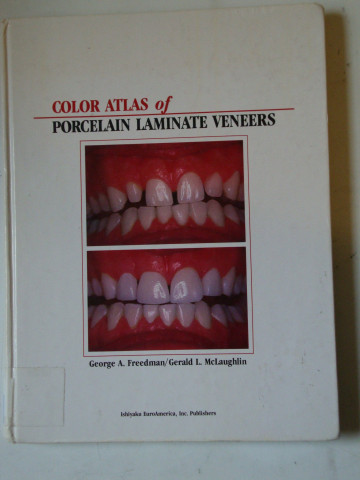 Color atlas of Laminate porcelain Veneers-1990