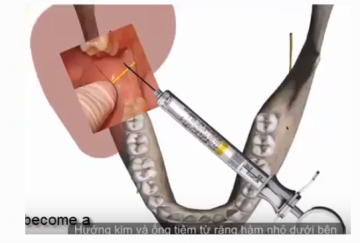 Một số kỹ thuật gây tê thường dùng-Phần 3 gây tê gai spix.A