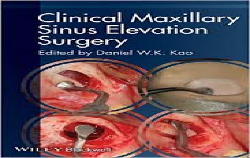 Clinical Maxillary Sinus Elevation Surgery-download