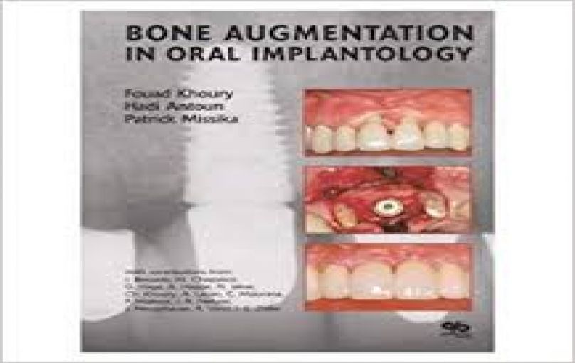 Bone Augmentation In Oral Implantology-download