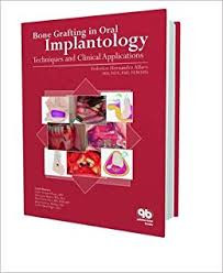 BONE GRAFTING IN ORAL IMPLANTOLOGY-2006