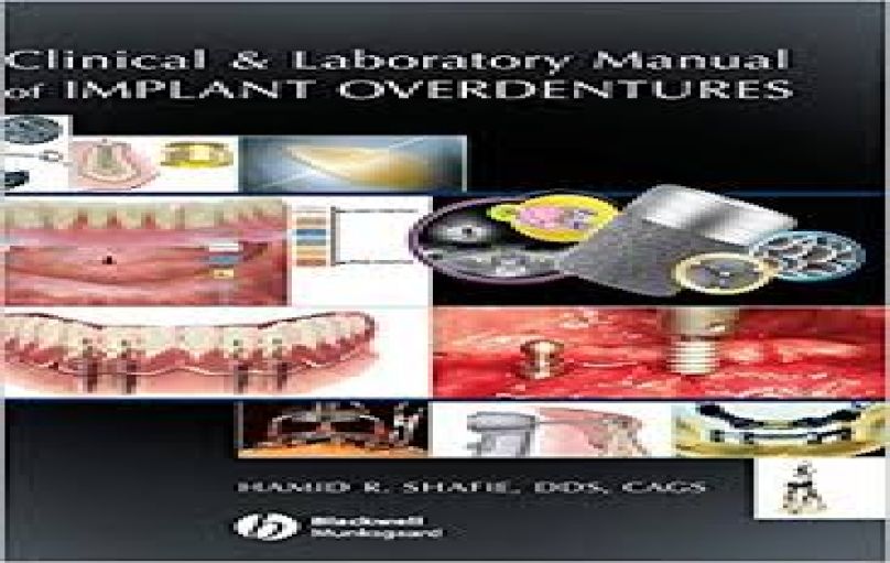 Clinical and Laboratory Manual of Implant Overdentures-download