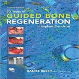 20 Years of Guided Bone Regeneration in Implant Denistry, 2ed (2009)