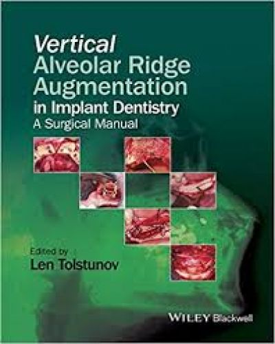 Vertical Alveolar Ridge Augmentation in Implant dentistry