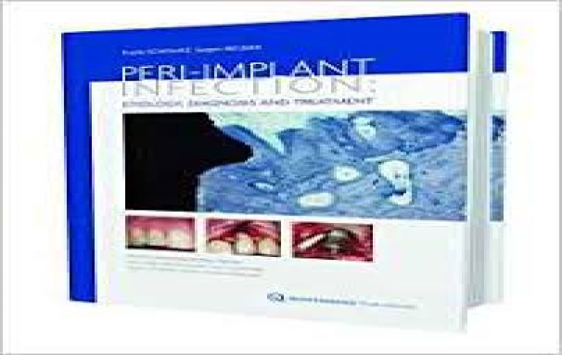 Peri-implant Infection Etiology, Diagnosis and Treatment-download