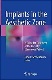 Implants in the Aesthetic Zone- A Guide for Treatment