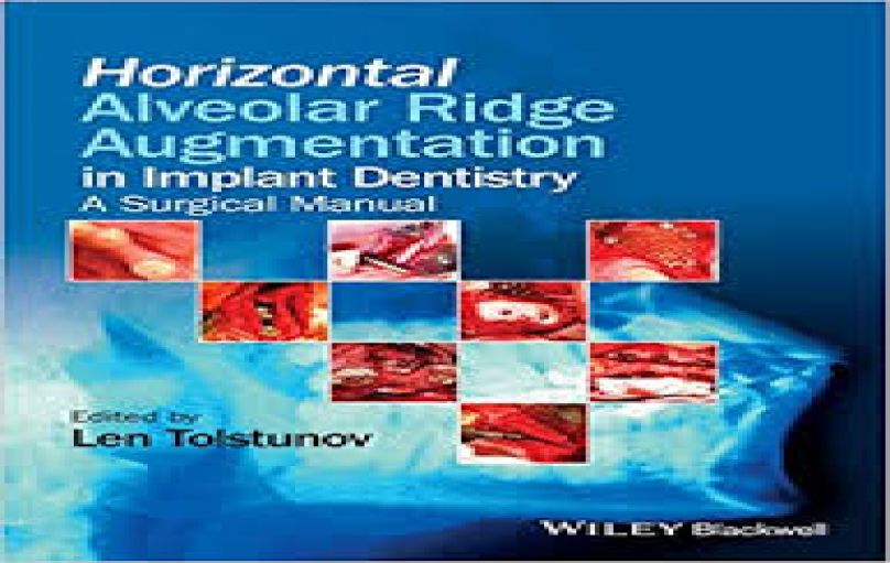 Horizontal Alveolar Ridge Augmentation in Implant Dentistry -download