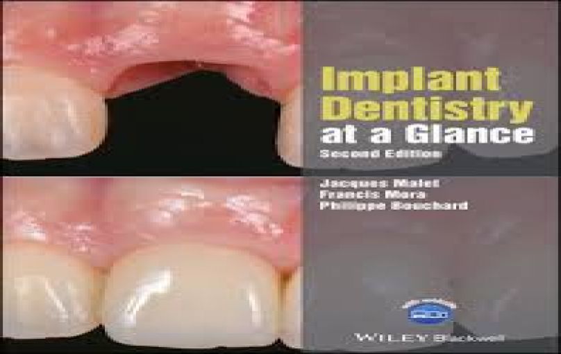 Implant Dentistry at a Glance-2nd-2018-download