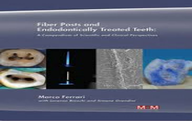 Fiber Posts and Endodontically Treated Teeth-2008-download