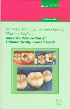 Adhesive Restoration of Endodontically Treated Teeth