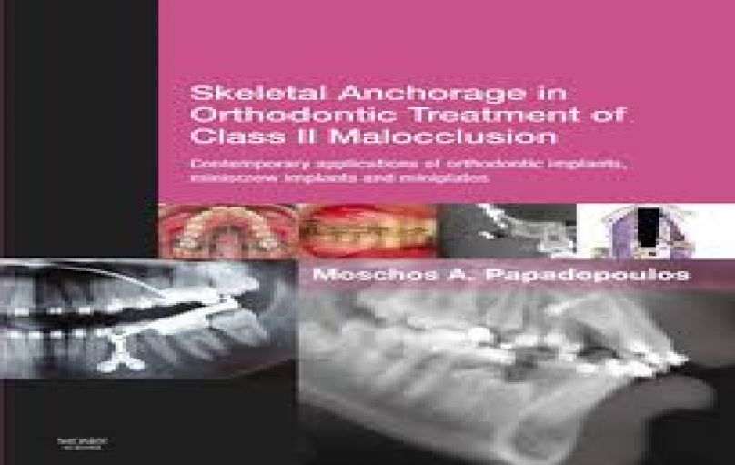 Skeletal Anchorage in Orthodontic Treatment of Class II Malocclusion-download