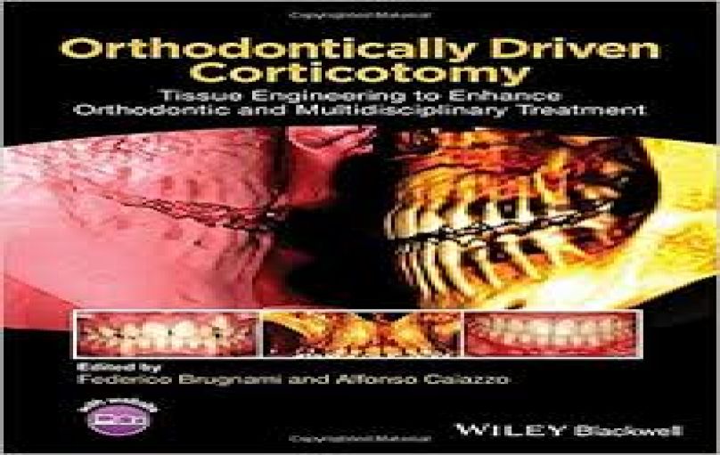 Orthodontically Driven Corticotomy-download