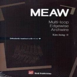 MEAW (Multi-loop Edgewise Archwire) Orthodontic treatment with MEAW