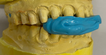 Hướng dẫn lấy dấu cắn và ứng dụng lâm sàngPHần2