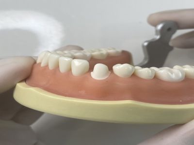 Video hướng dẫn sửa soạn cùi răng nanh hàm dưới,a1