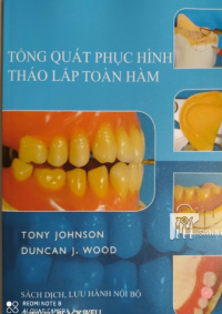 TỔNG QUAN PHỤC HÌNH THÁO LẮP TOÀN HÀM